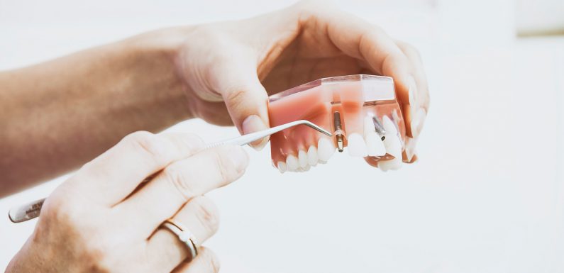 Kompendium wiedzy o implantach zębowych! Wszystko co musisz wiedzieć!