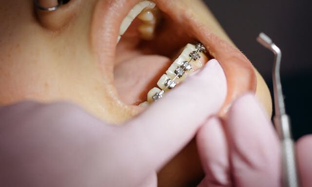 Na czym polega ortodontyczne leczenie przodozgryzu?