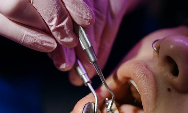 Jak wyglądają zęby bezpośrednio po zdjęciu aparatu ortodontycznego?