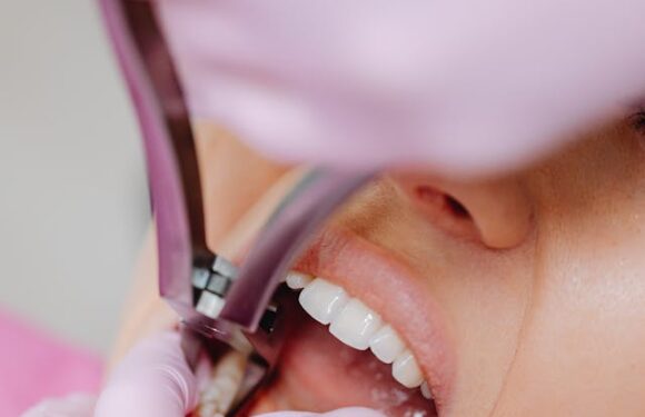 Czy wypełnienia stomatologiczne przebarwiają się z czasem?