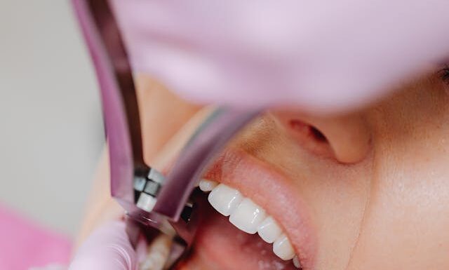 Czy wypełnienia stomatologiczne przebarwiają się z czasem?