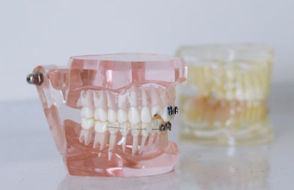 Czy protezy ruchome acetalowe przebarwiają się z czasem?