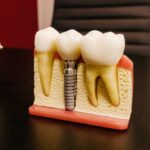 Jak długo wytrzymuje implant zęba?