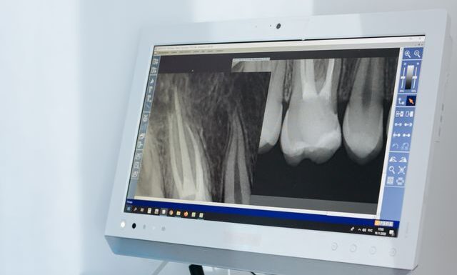 Czy pantomogram pokaże, dlaczego ząb nie wyrżnął się prawidłowo?